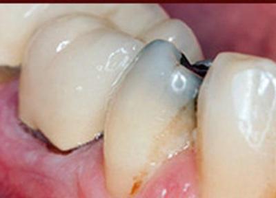 پوسیدگی دندان سرطان روده را وخیم تر می کند